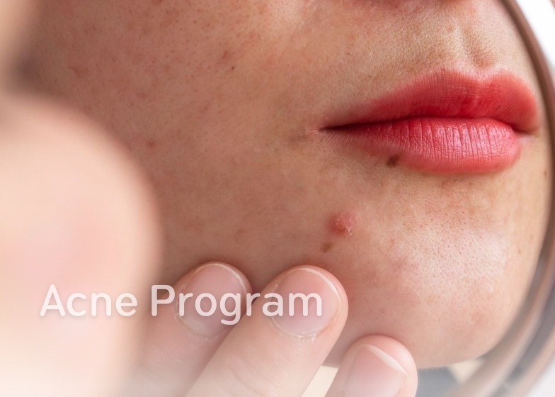 Acne Program